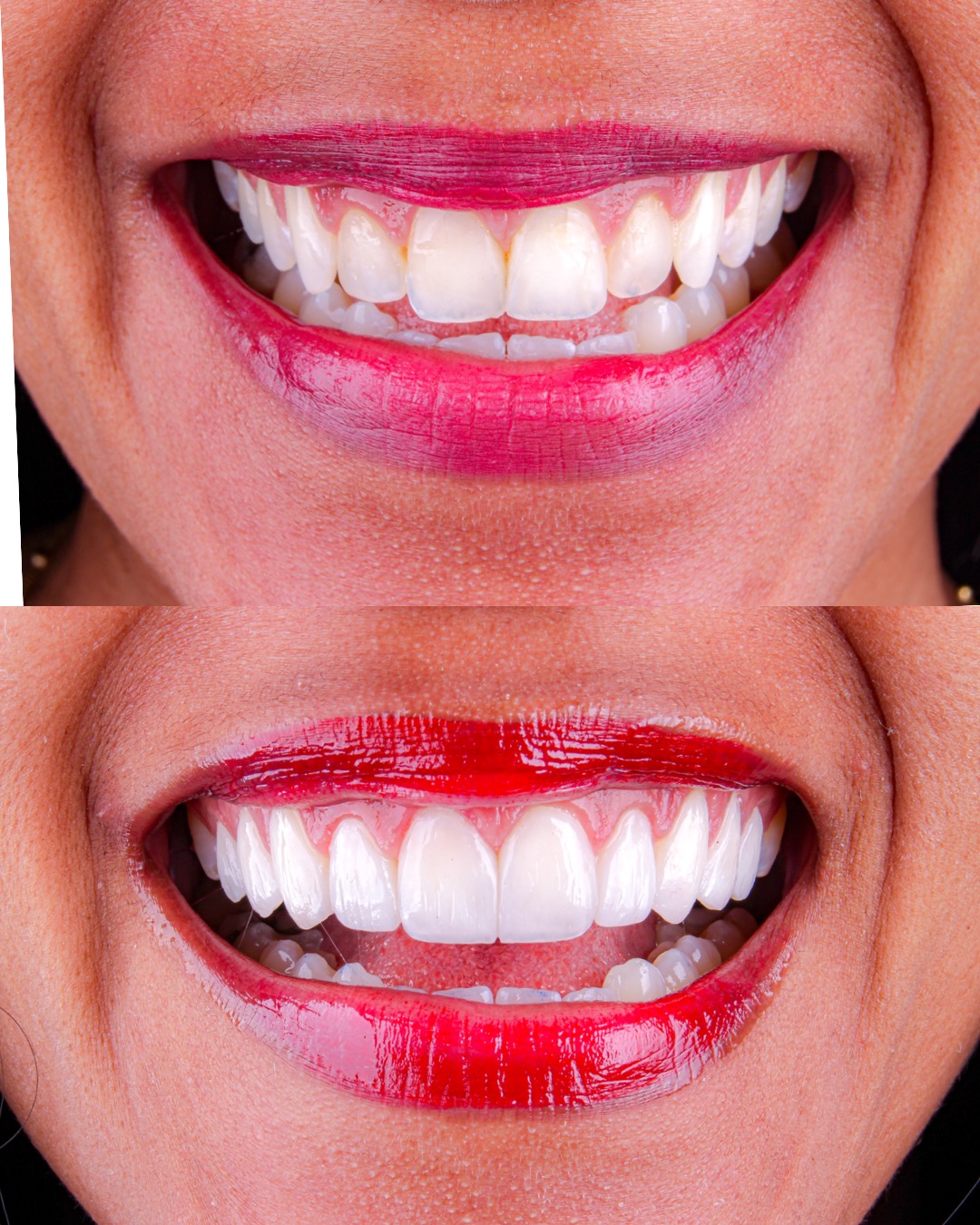 Caso 02 — Facetas em Resina — antes e depois