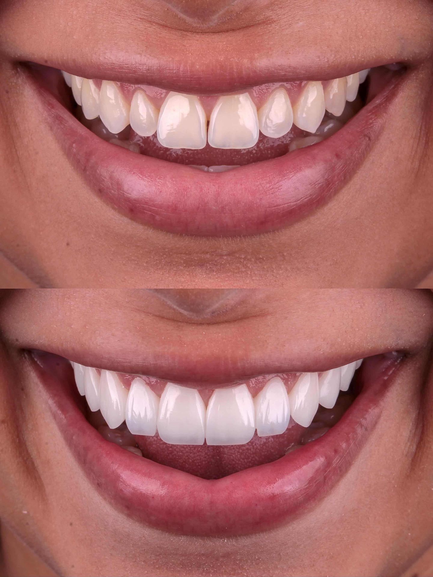 Caso 08 — Reabilitação Estética — antes e depois