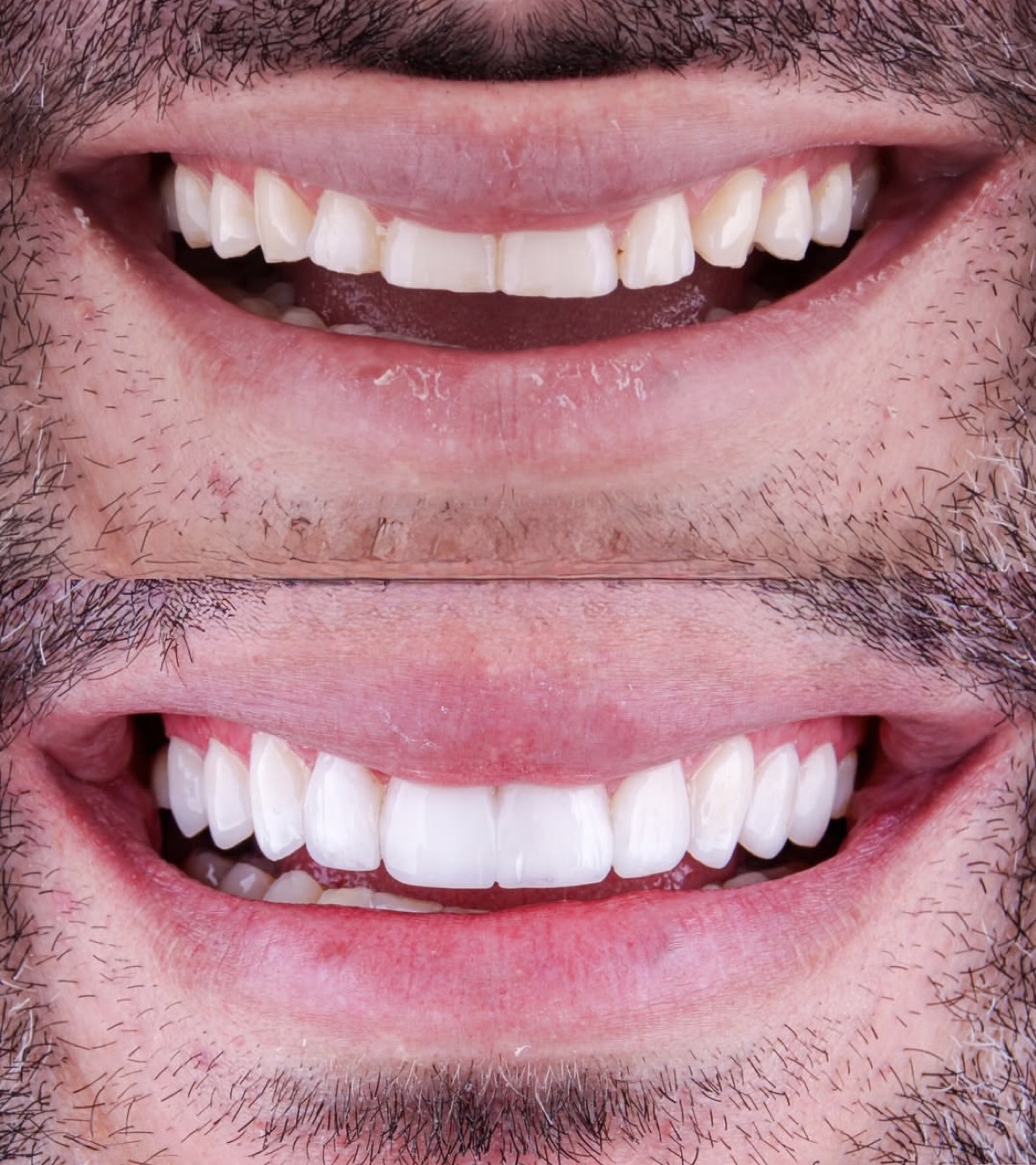 Caso 01 — Lentes de Contato — antes e depois
