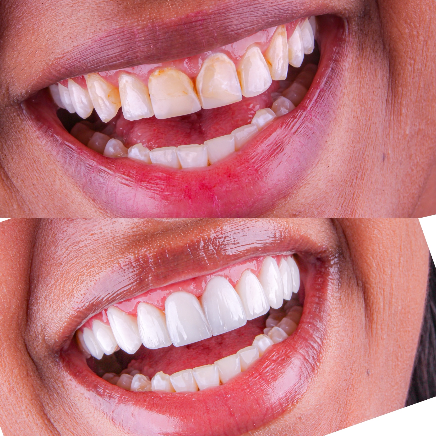 Caso 10 — Reabilitação com Lentes — antes e depois